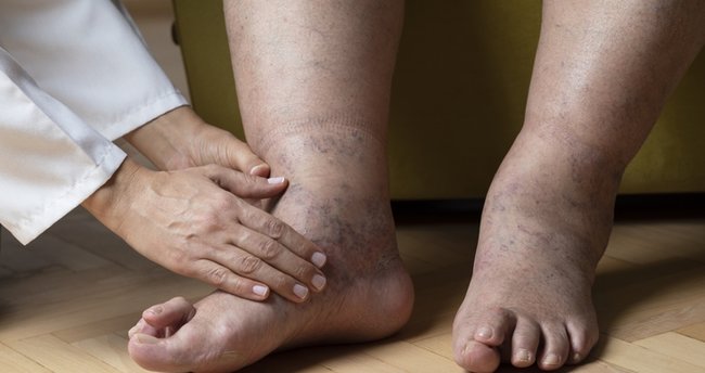 vücuttaki ödem nasıl atılır